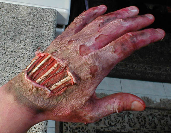 hand road rash finish